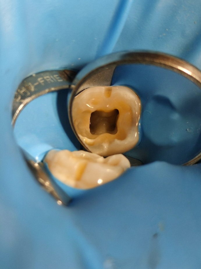 Root Canal Treatment (RCT)